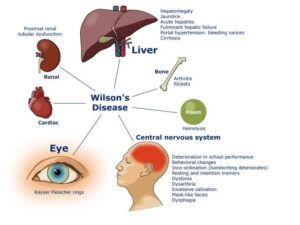Image illustrating Wilson's disease, showing copper buildup in the liver and brain, representing the genetic disorder that affects liver function and neurological health.